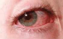 6 Effective Home Remedies To Treat Eye Strain