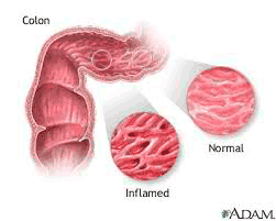 Home Remedies for Inflammatory Bowel Disease – Foods To Eat And Avoid