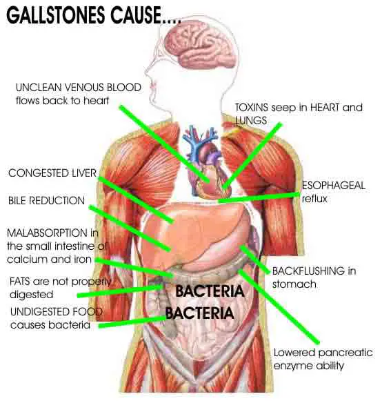 Gallstones Diet