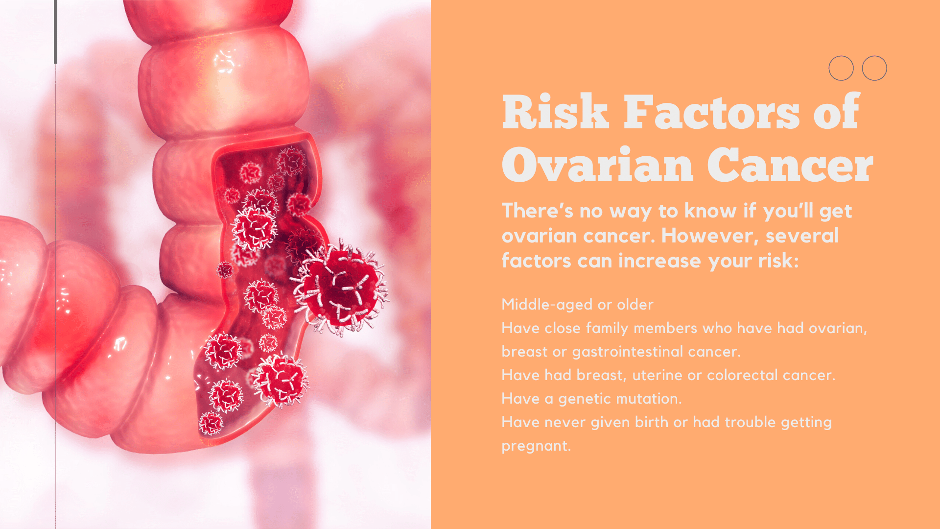 ovarian cancer risk factors