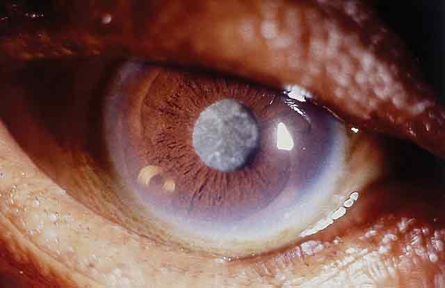 Cataract, lasik, extracapsular cataract extraction, lasik complications