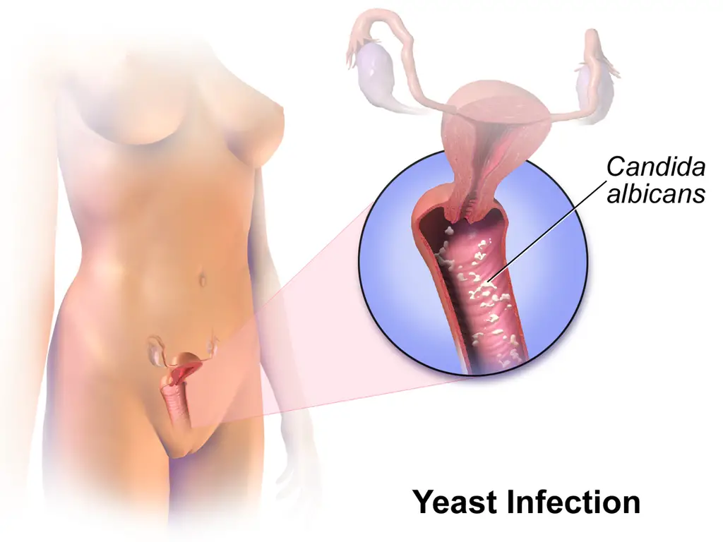 Yeast Infection Home Remedies