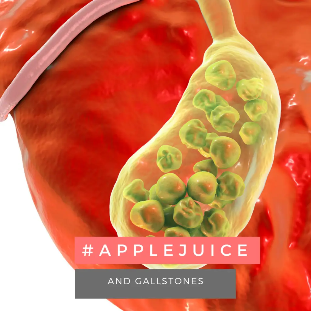 apple juice benefits for gallstones