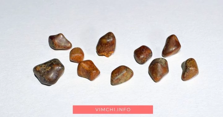 gallstone formation